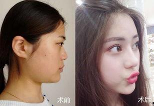 网红的隆鼻医生,技艺精湛，美丽蜕变背后的秘密